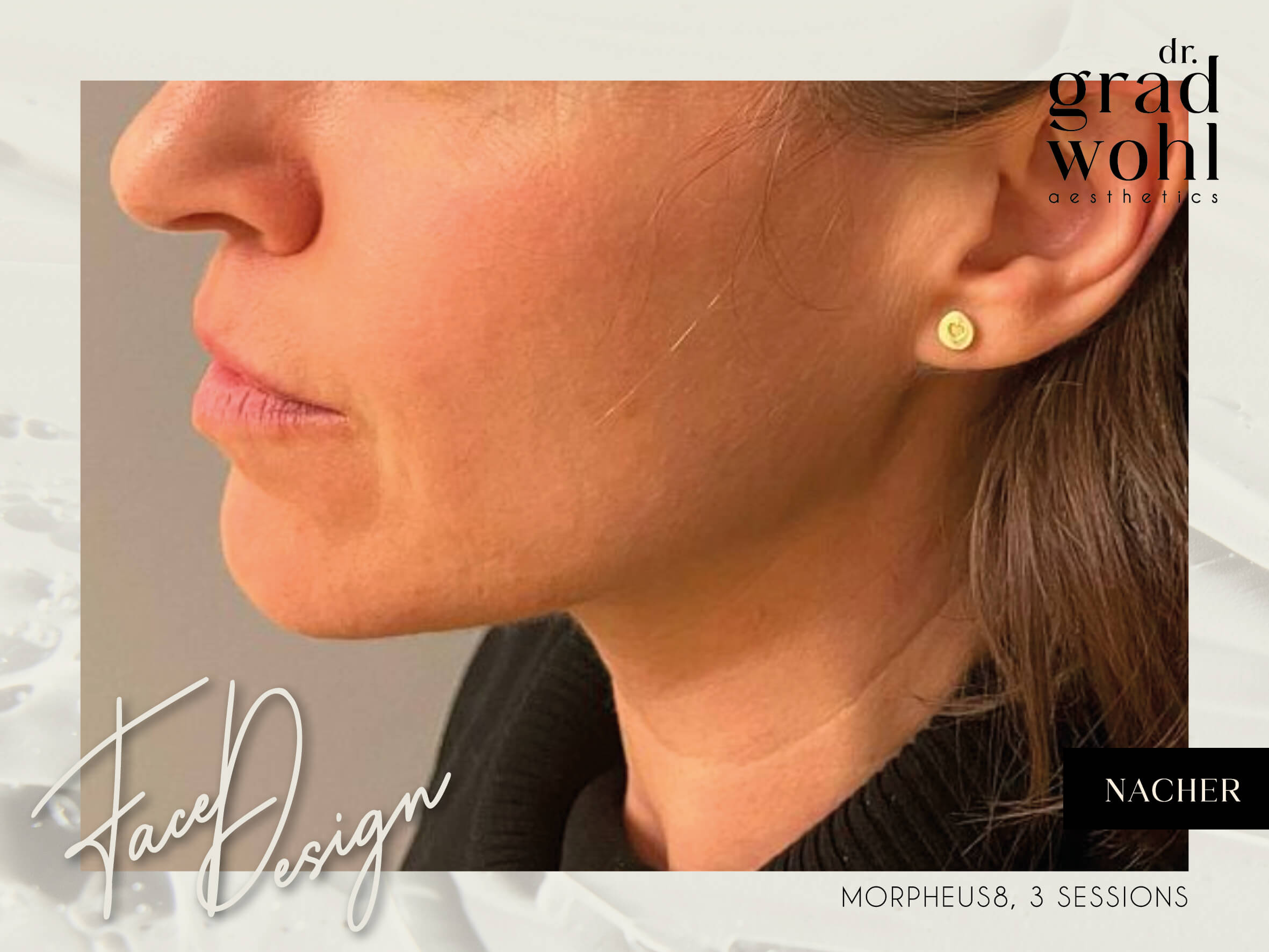 Gesichtsstraffung, Jawline Contouring - Nachher