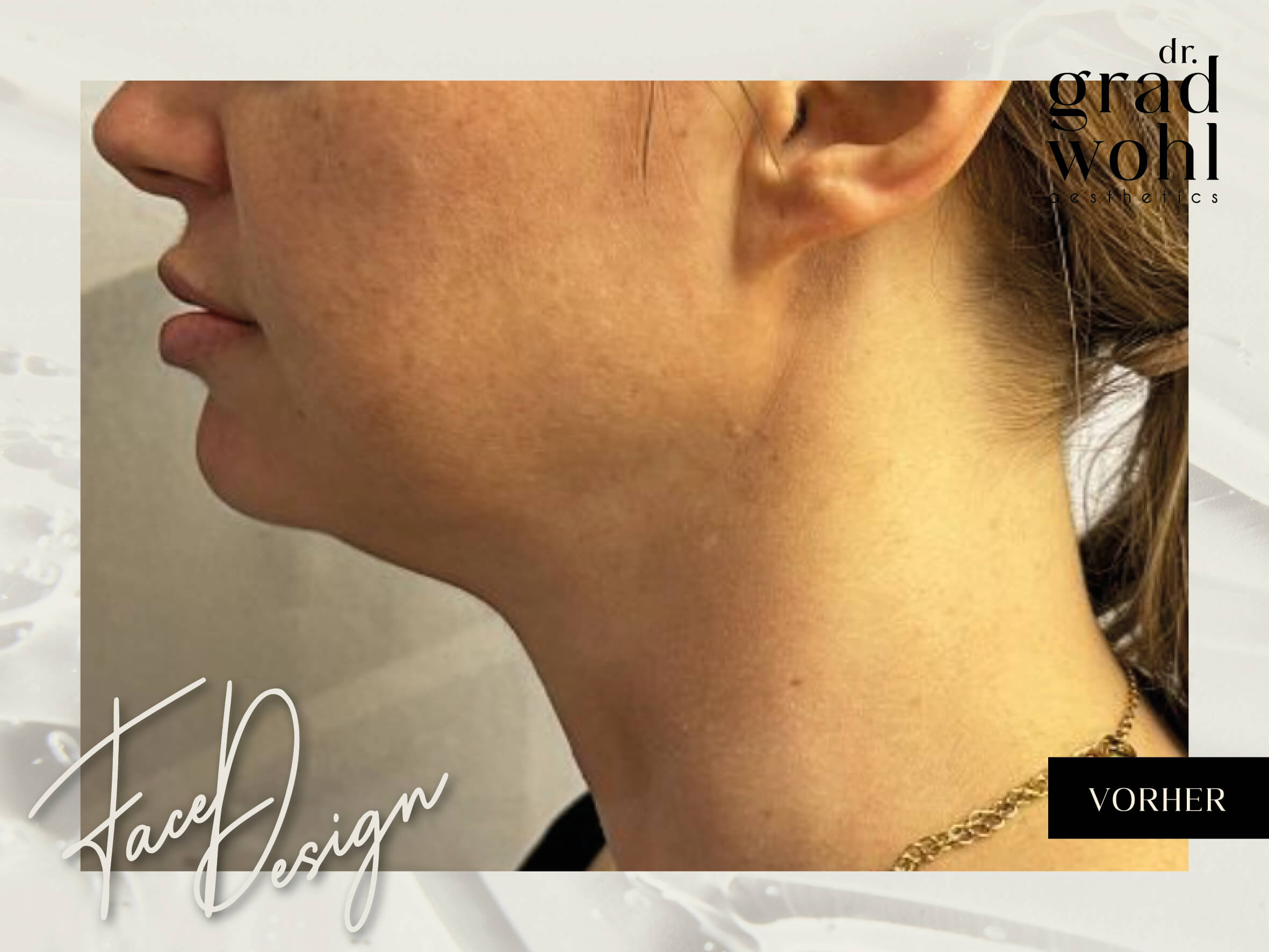 Jawline Contouring, kleines Doppelkinn - Vorher