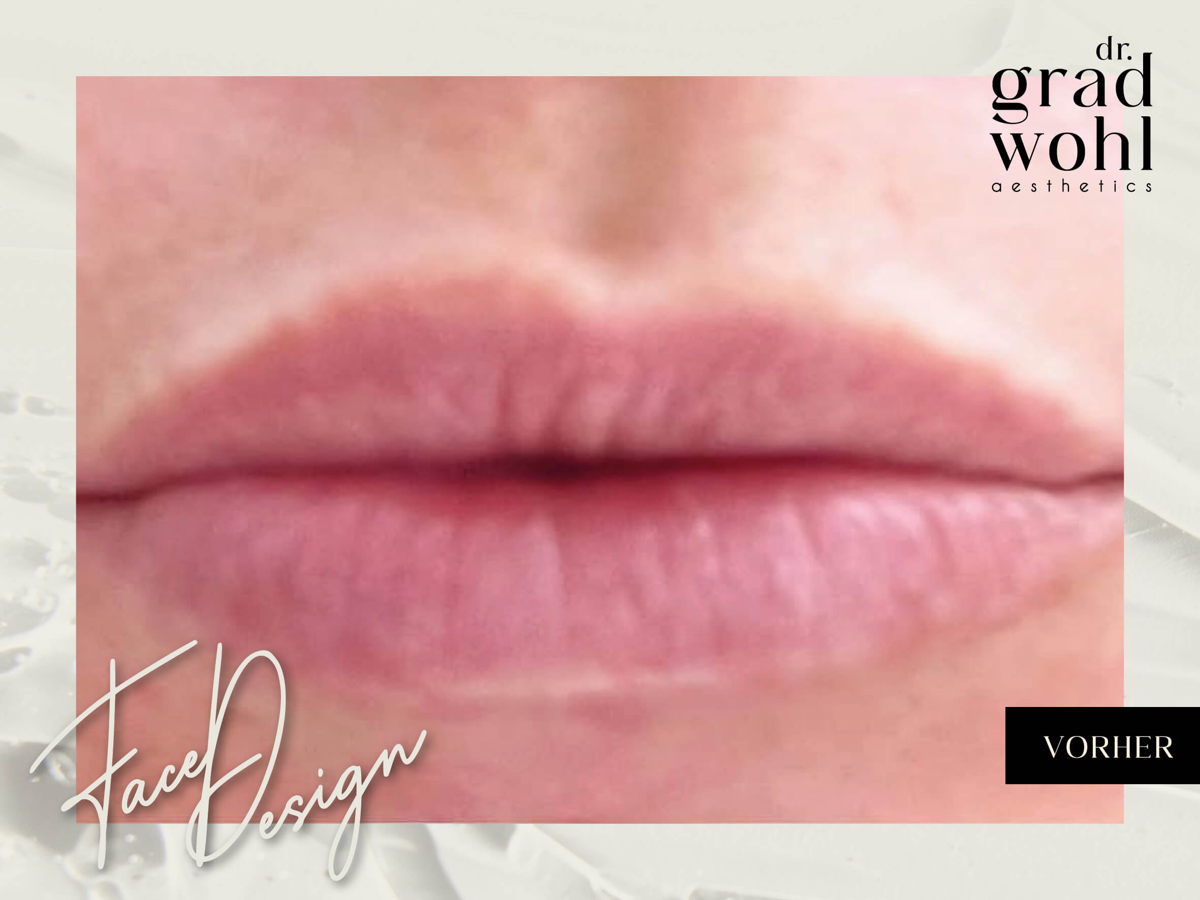 Lippenaufspritzung - Vorher
